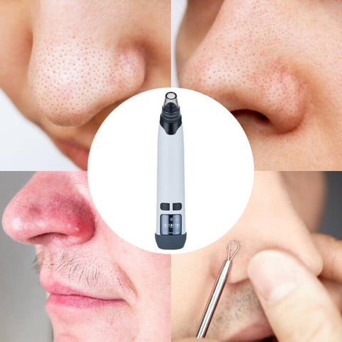Pore Vacuum Blackhead and Whitehead Remover for Nose and Face - onlinemegasale.com