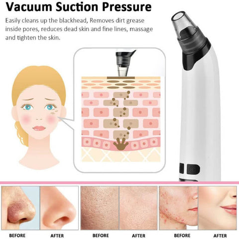 Pore Vacuum Blackhead and Whitehead Remover for Nose and Face - onlinemegasale.com