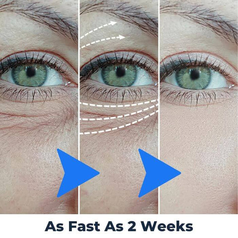 Therapeutic Eye Massager for Dark Circles, Puffiness, and Under-Eye Bags - onlinemegasale.com