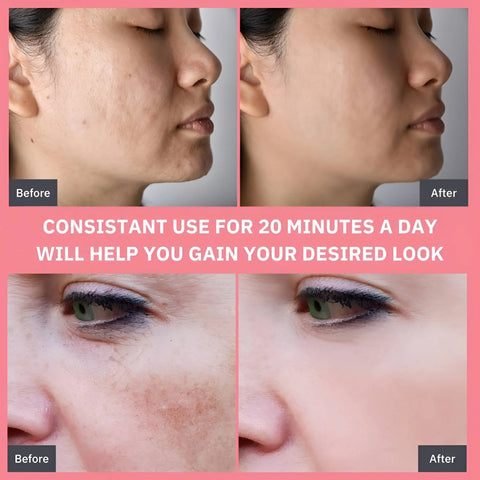 Hydrodermabrasion Blackhead Remover And Vacuum Pore Cleaner - onlinemegasale.com