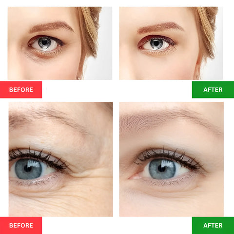 RF Radio Frequency Eye Skin Tightening Device - onlinemegasale.com
