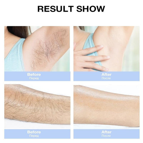 Professional Laser Hair Remover Machine - onlinemegasale.com