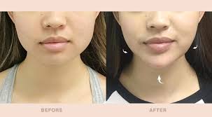 Slimming Face Lift Band - onlinemegasale.com