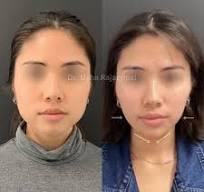 Slimming Face Lift Band - onlinemegasale.com