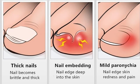 40% OFF🔥Professional Nail Clipper Kit - onlinemegasale.com