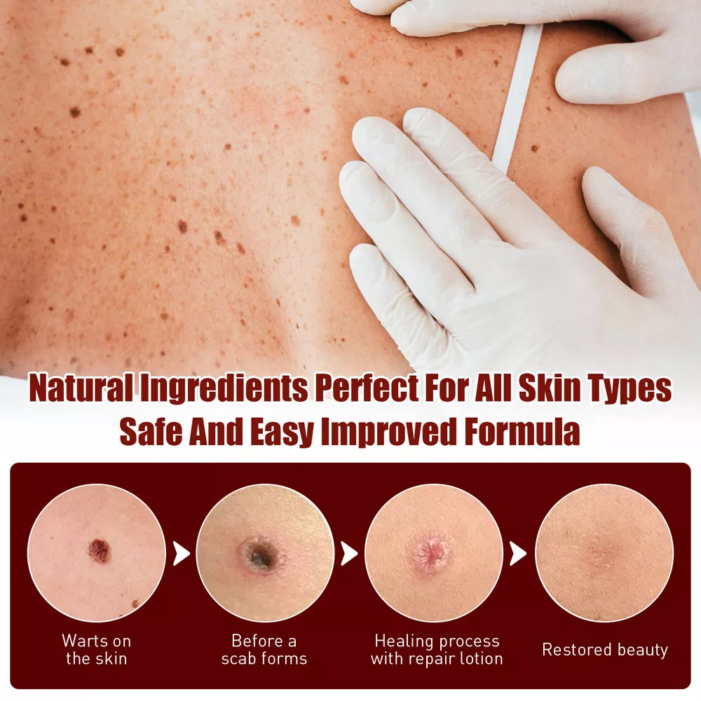 Tags & Moles Remover – Quick & Scar-Free Solution for Skin Tags & Warts - onlinemegasale.com