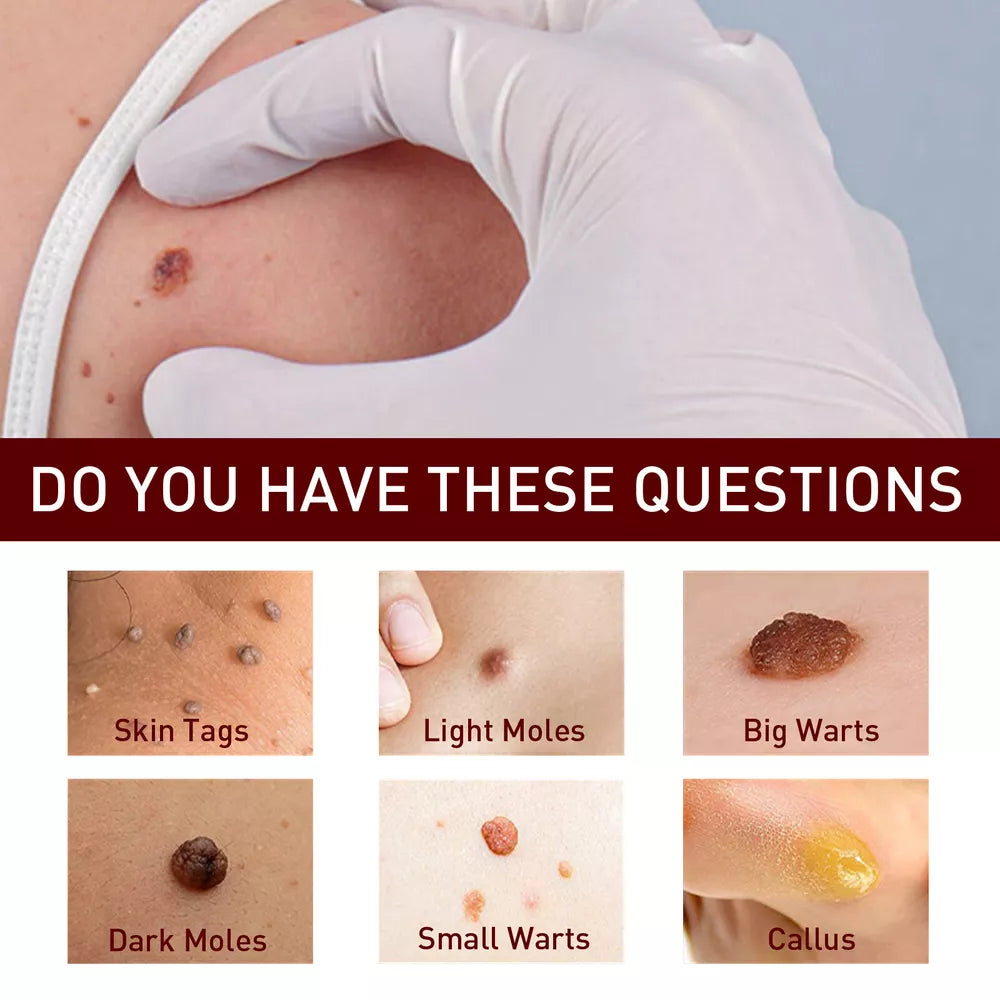 Tags & Moles Remover – Quick & Scar-Free Solution for Skin Tags & Warts - onlinemegasale.com