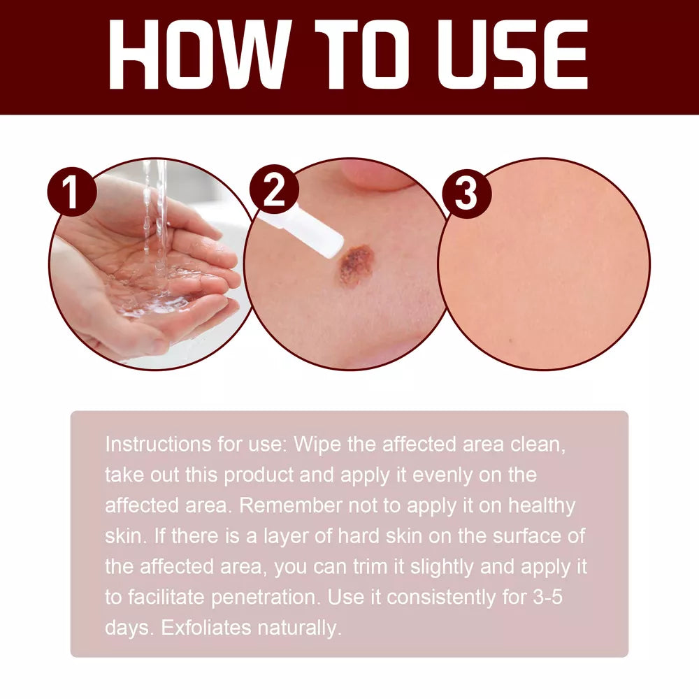 Tags & Moles Remover – Quick & Scar-Free Solution for Skin Tags & Warts - onlinemegasale.com