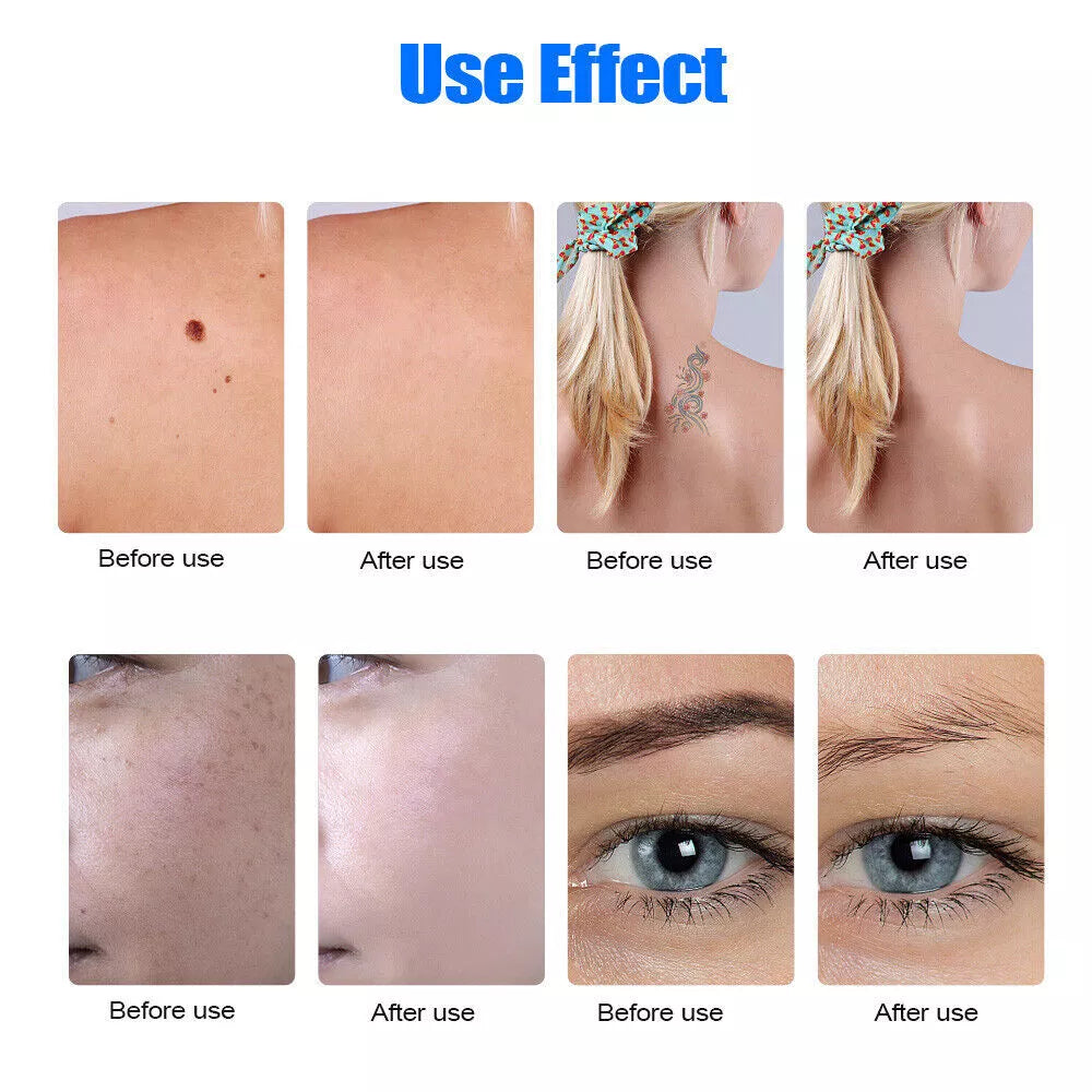 Tattoo Removal Laser Pen Dark Spot, Mole, Scar Removal Pen | Tattoo Removal Near Me - onlinemegasale.com Tattoo Removal Laser Pen Dark Spot, Mole, Scar Removal Pen | Tattoo Removal Near Me - onlinemegasale.com