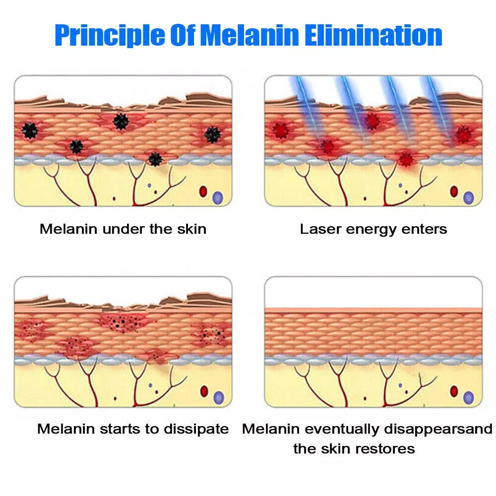 Tattoo Removal Laser Pen Dark Spot, Mole, Scar Removal Pen | Tattoo Removal Near Me - onlinemegasale.com Tattoo Removal Laser Pen Dark Spot, Mole, Scar Removal Pen | Tattoo Removal Near Me - onlinemegasale.com